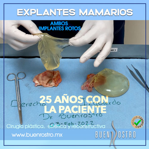 Cirugías de explantes mamarios