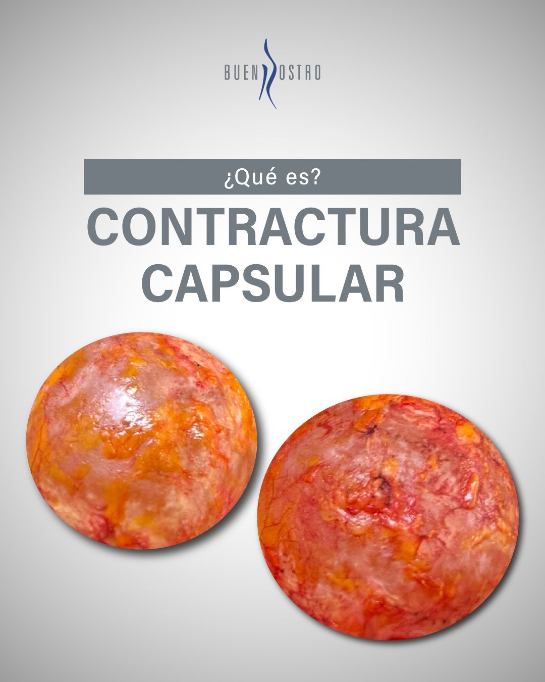 No todas las molestias después de un implante son normales.
 Cuando el cuerpo reacciona, es importante entender qué está ocurriendo y no normalizar el dolor o los cambios físicos.
 La información médica adecuada permite actuar con mayor seguridad y tranquilidad.
🩺 La detección oportuna y una revisión médica adecuada hacen la diferencia en cada caso.