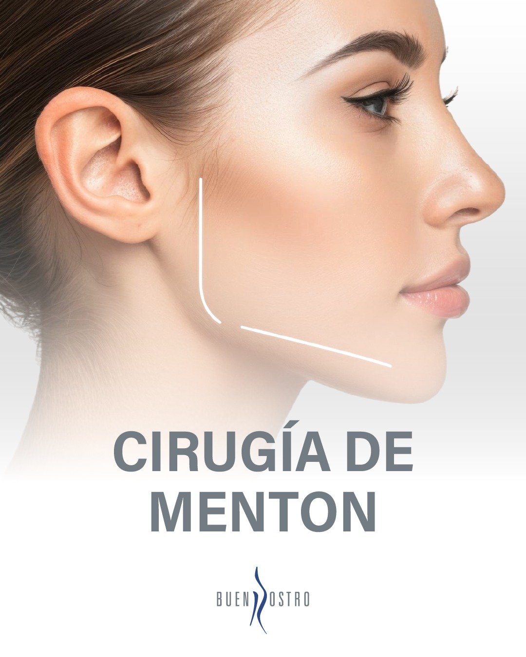La armonía facial empieza con el mentón. Su forma influye en el equilibrio del rostro, el perfil y la proporción con la nariz y la frente. ✨ Si has notado asimetría o falta de definición, existen opciones médicas para mejorarla.

📩 Escríbenos y recibe orientación personalizada.