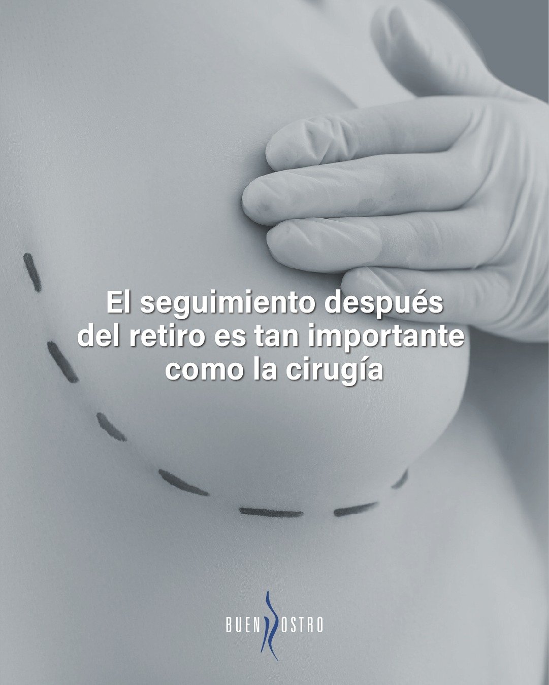 La explantación no termina en quirófano 🏥
El verdadero cambio continúa en cada revisión, en cada evaluación y en cada etapa del proceso de recuperación.
Porque el seguimiento es tan importante como la cirugía 🔎
Tu cuerpo merece acompañamiento, no solo un procedimiento 🤍
Si estás considerando realizarte una explantación, realiza una valoración.
 Resolvemos todas tus dudas y te acompañamos con seguimiento médico adecuado durante todo el proceso.✨