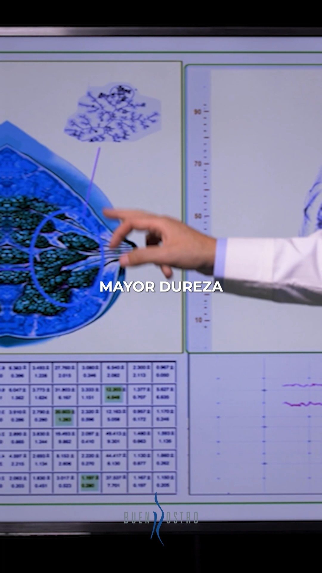Si tienes implantes mamarios, es importante conocer la clasificación de Baker, que evalúa el grado de endurecimiento del seno por contractura capsular.
En el grado 1 y 2, el seno luce normal o casi normal, no hay dolor y la prótesis se siente suave o ligeramente firme 🤔. Muchas veces pasa desapercibido.
En el grado 3, el seno ya se percibe duro, hay cambios visibles en la forma y comienza la molestia ⚠️. Aquí ya es una señal de alerta.
En el grado 4, el endurecimiento es evidente, hay dolor y la deformidad es clara 🚨. En estos casos, es necesario intervenir.
Cuando la contractura es avanzada (grado 3 y 4), el tratamiento suele requerir retirar la cápsula que rodea el implante mediante una capsulectomía, y en muchos casos retirar o cambiar la prótesis.
Detectarlo a tiempo hace toda la diferencia. Si notas cambios, no lo normalices.
Acude a valoración en Buenrostro Medical Center.
