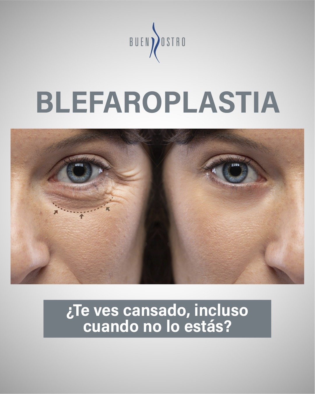 No siempre es cansancio: a veces, la mirada también refleja cambios en los párpados. 👁️✨

La blefaroplastia puede devolver frescura, naturalidad y en algunos casos hasta funcionalidad.

📩 Agenda tu valoración.