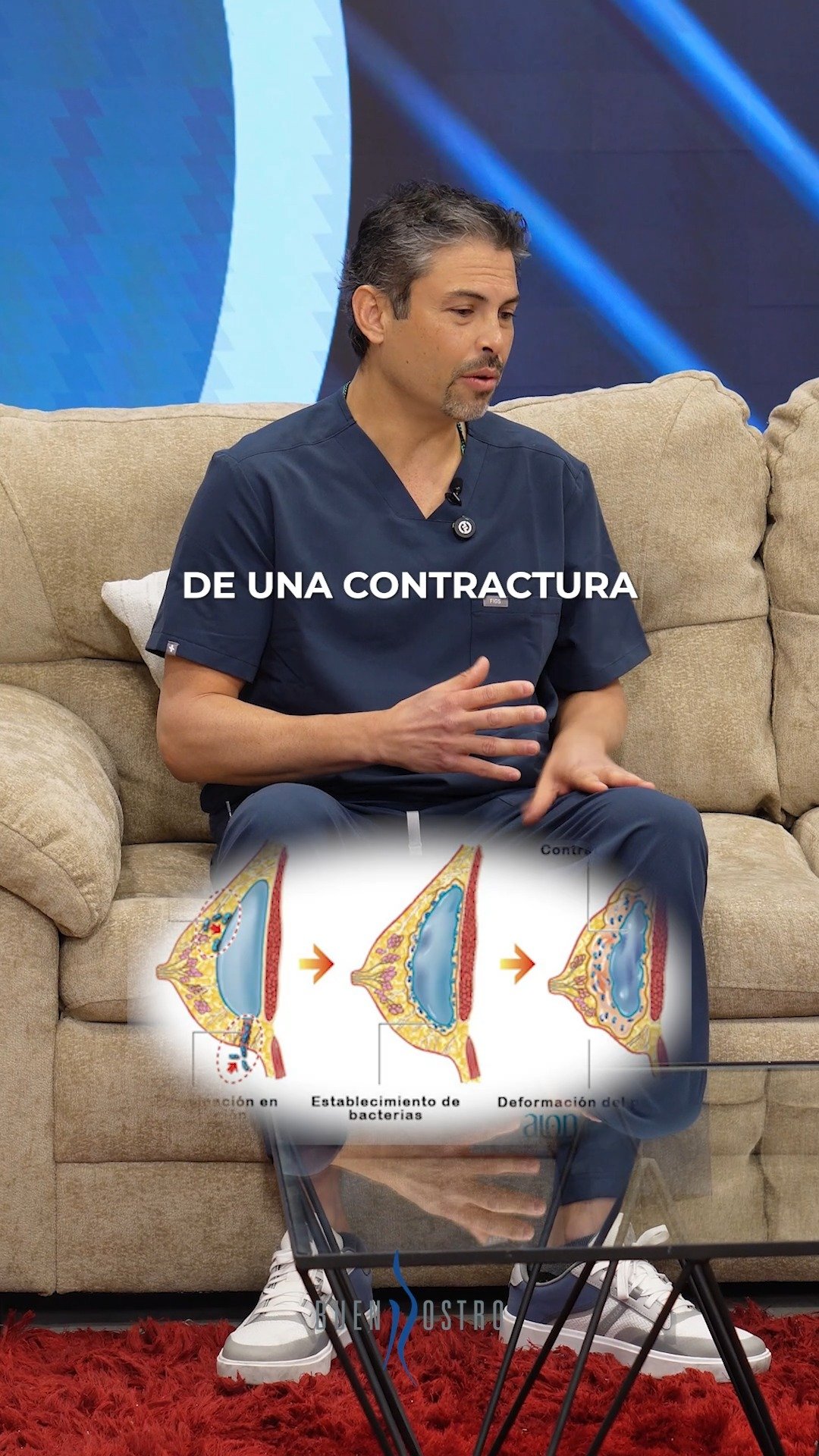 Cuando una contractura capsular avanza a grados 3 o 4 (clasificación de Baker), ya no es solo un tema estético ⚠️
El implante puede endurecerse, deformarse y provocar dolor constante.
La mama puede cambiar de forma, elevarse o volverse asimétrica, afectando tanto el resultado como la comodidad de la paciente.
Si no se trata, las molestias suelen empeorar y el tejido alrededor del implante puede volverse cada vez más rígido.
En estos casos, sí suele ser necesario retirar o cambiar el implante, junto con el manejo de la cápsula (capsulectomía) para corregir el problema 💉
Y algo importante:
si ya tuviste contractura capsular, existe mayor probabilidad de que vuelva a presentarse, incluso con un nuevo implante.
Por eso, la valoración individual y el seguimiento con un cirujano experimentado es clave para tomar la mejor decisión 👩🏻⚕️