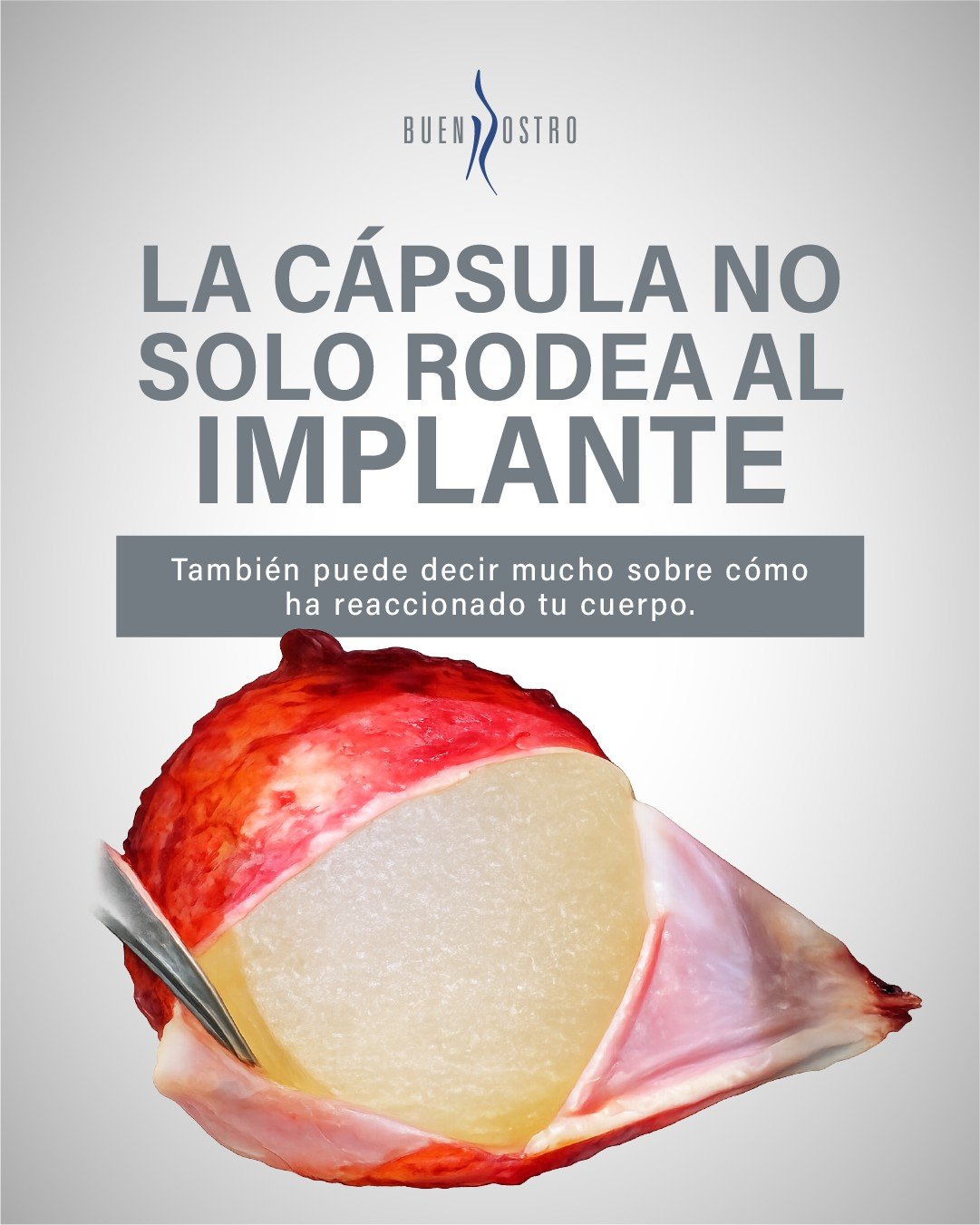 🧠 La cápsula no solo rodea al implante… también habla de cómo reacciona tu cuerpo.

Ignorarla puede ser ignorar información importante.

📩 Infórmate antes de tomar decisiones sobre tus implantes.