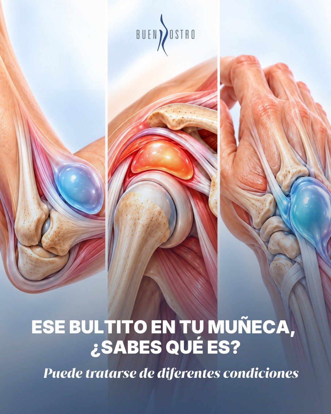 ¿Ese pequeño bulto en tu muñeca apareció de la nada? 👀
Aunque algunas lesiones pueden parecer similares, existen diferentes causas, como un higroma, bursitis o quiste sinovial. La causa y
los síntomas son los que determinarán el tratamiento más adecuado. Por eso, no todos los bultos deben tratarse de la misma manera.
📲 Si notas un bulto, dolor o cambios en la muñeca, agenda una valoración.
📩 Agenda una valoración especializada. CE: 244898. AVISO DE PUBLICIDAD: 2414102002A00654