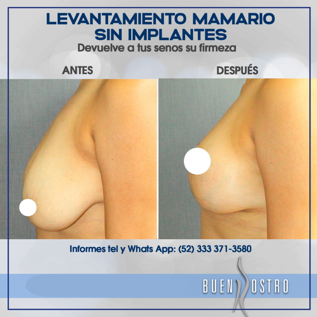 MASTOPEXIA 1