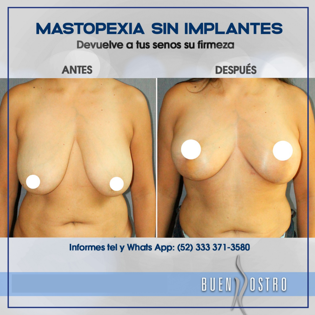 MASTOPEXIA