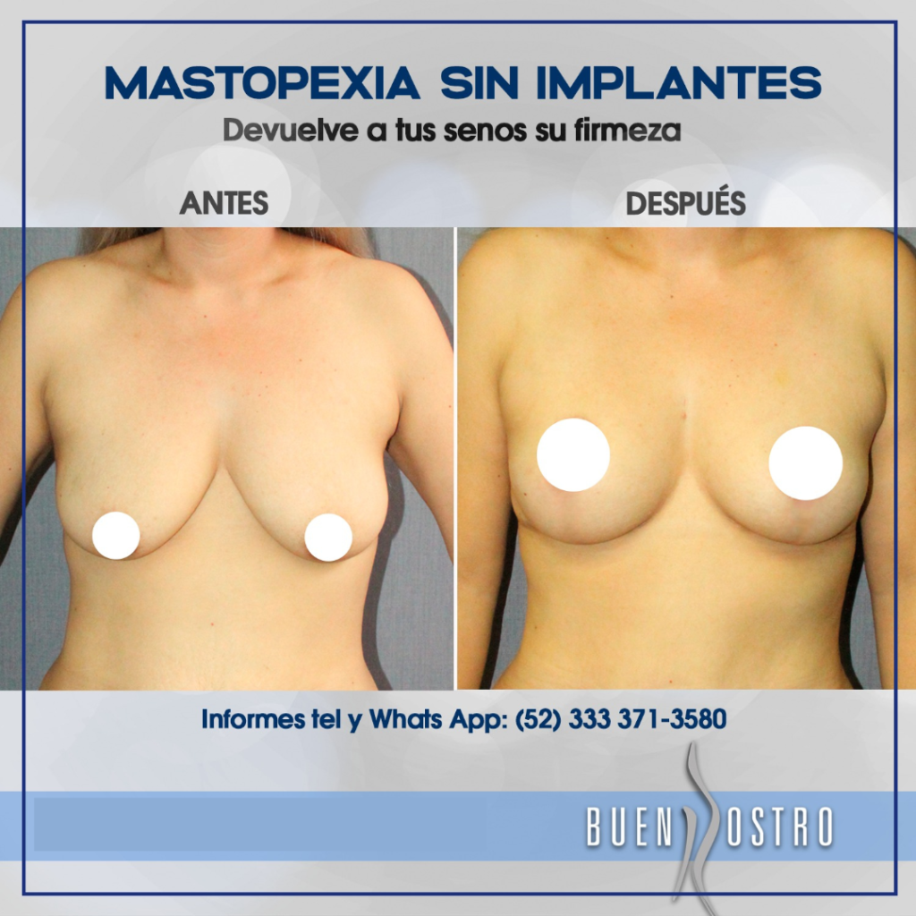 MASTOPEXIA 4